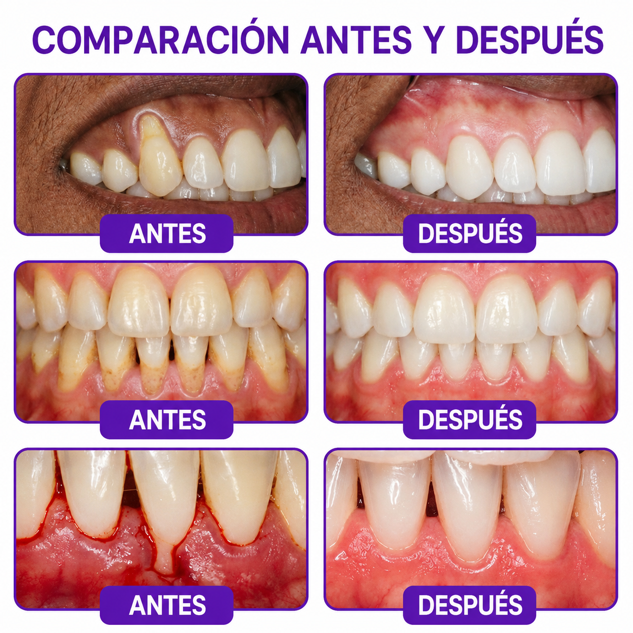 墨西哥 GLIMMERLY® VioCore: pasta dentífrica para el tratamiento de la gingivitis y la periodontitis con veneno de abeja