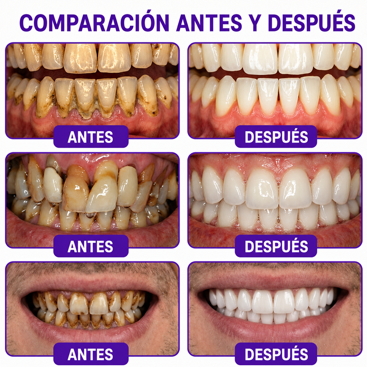 墨西哥 GLIMMERLY® VioCore: pasta dentífrica para el tratamiento de la gingivitis y la periodontitis con veneno de abeja